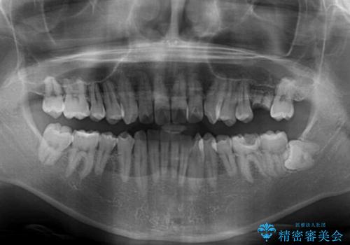 前歯のクロスバイトと抜歯が必要な奥歯の虫歯 インビザラインとインプラント治療の治療前