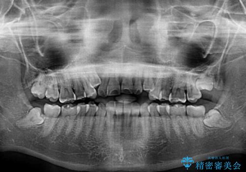 目立ちにくい抜歯矯正 ハーフリンガルの治療前