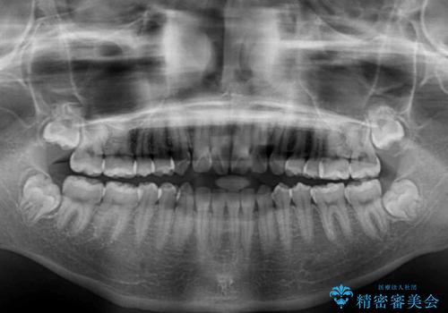 話しにくいオープンバイト ワイヤー装置による抜歯矯正治療の治療前