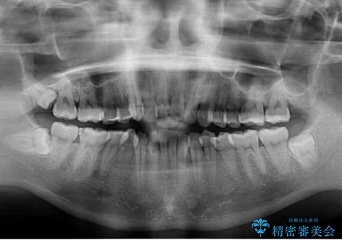 転んで前歯が欠けた 折れた前歯をきっかけに矯正治療で歯列をきれいに整えるの治療前
