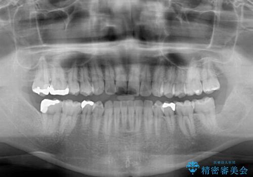 インビザライン・ライトによる矯正治療の後戻り改善の治療前