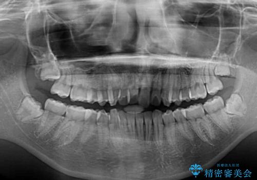 就職前にきれいな歯並びにしたい 大学生のインビザライン矯正の治療前