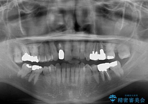 下の歯が前に出てしまう咬み合わせを治したい インビザラインによる矯正治療の治療前