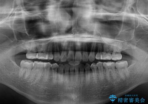 話しにくいオープンバイト ワイヤー装置による抜歯矯正治療の治療後