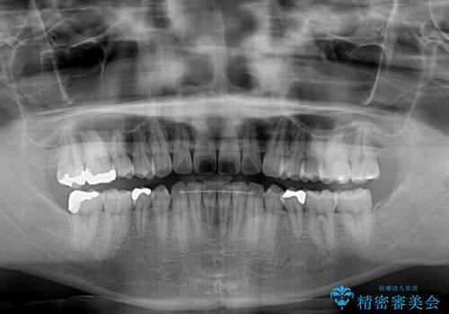 インビザライン・ライトによる矯正治療の後戻り改善の治療後