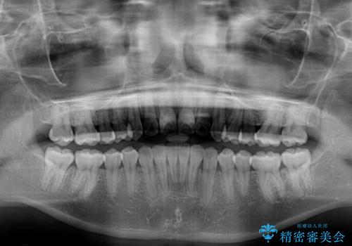 インビザラインを用いた非抜歯矯正の治療後