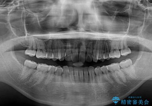 就職前にきれいな歯並びにしたい 大学生のインビザライン矯正の治療後