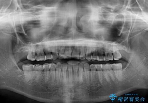 目立ちにくい抜歯矯正 ハーフリンガルの治療後