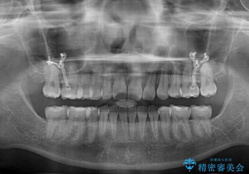 治療途中で転院 抜歯矯正の仕上げ治療の治療後