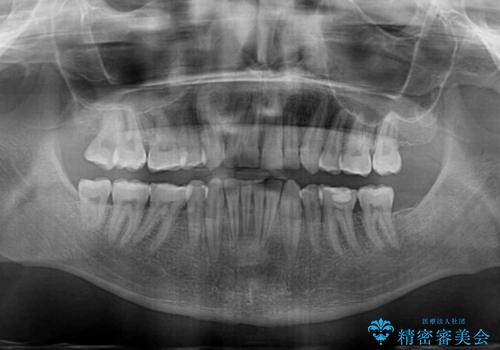 抜歯矯正の後戻りが気になる インビザライン・ライトによる矯正治療の治療後