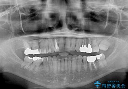 下の歯が前に出てしまう咬み合わせを治したい インビザラインによる矯正治療の治療後