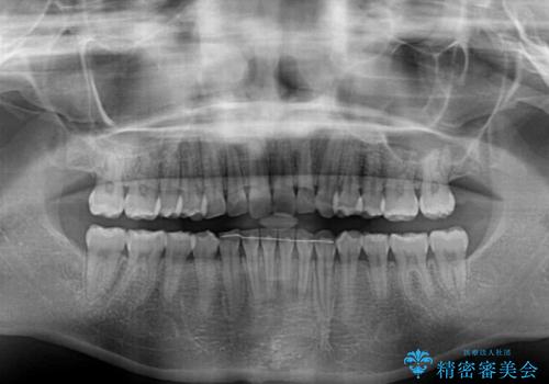 顎が痛くなる咬み合わせが気になる　想定していなかった矯正治療を行うことにの治療後