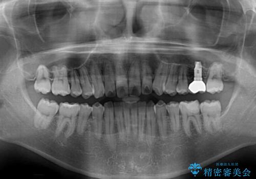 前歯のクロスバイトと抜歯が必要な奥歯の虫歯 インビザラインとインプラント治療の治療後