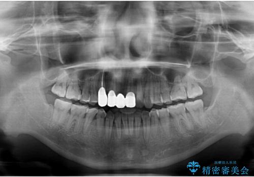 転んで前歯が欠けた 折れた前歯をきっかけに矯正治療で歯列をきれいに整えるの治療後