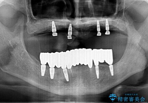 [ 重度歯周病 ] インプラント・義歯による咬合再構築の治療後