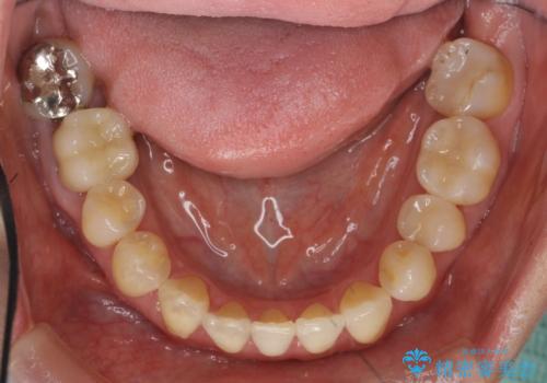 [ 矯正と補綴、総合歯科治療 ]  クロスバイトを避ける前歯部審美ブリッジの治療後