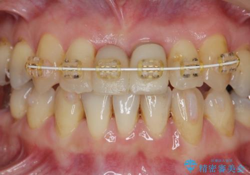 [ 矯正と補綴、総合歯科治療 ]  クロスバイトを避ける前歯部審美ブリッジ