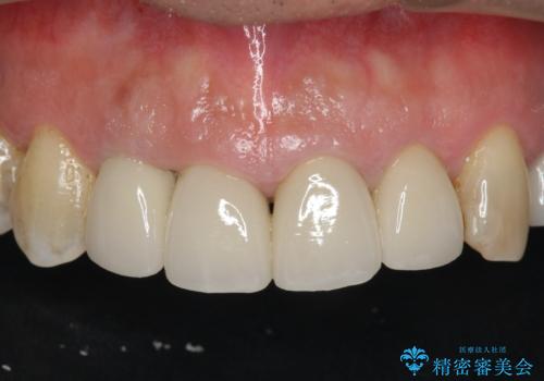 老朽化した前歯のクラウンやりかえの治療後