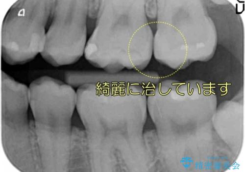 奥歯の虫歯 歯の間を広げてセラミックでしっかり治療の治療後
