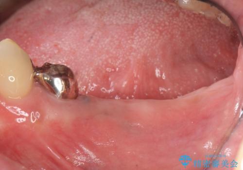 臼歯部インプラント補綴の症例 治療前