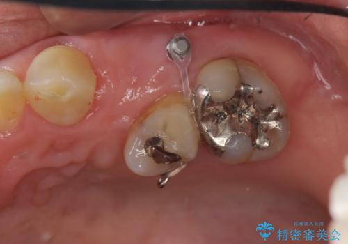 小矯正を伴う臼歯部ブリッジ治療の治療中