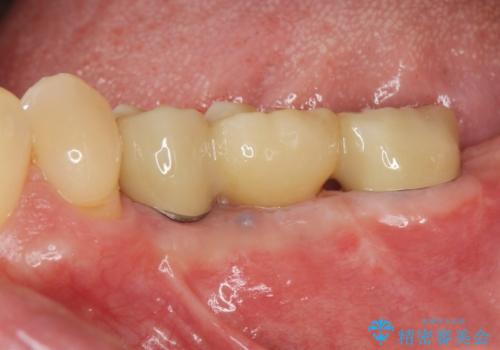 臼歯部インプラント補綴の症例 治療後
