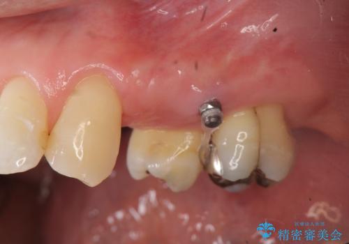 小矯正を伴う臼歯部ブリッジ治療の治療中