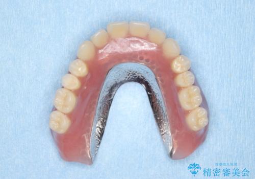 [ 重度歯周病 ] インプラント・義歯による咬合再構築