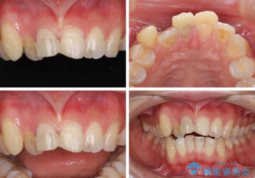 転んで前歯が欠けた 折れた前歯をきっかけに矯正治療で歯列をきれいに整えるの治療前