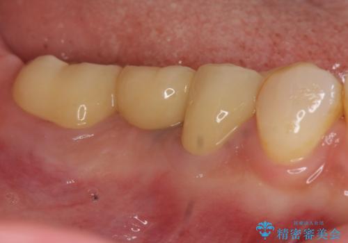 「ブリッジのところで噛むと痛い」 神経組織が原因の咬合痛