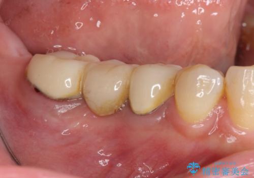 「ブリッジのところで噛むと痛い」 神経組織が原因の咬合痛の症例 治療前
