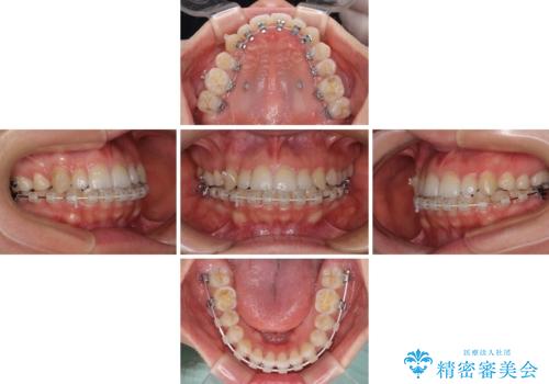 目立ちにくい抜歯矯正 ハーフリンガルの治療中