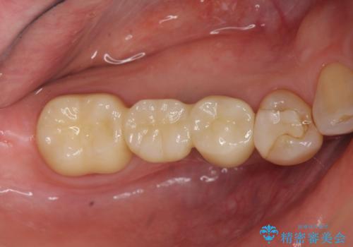 「ブリッジのところで噛むと痛い」 神経組織が原因の咬合痛の治療後