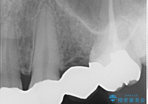 保険治療で装着したかぶせ物のやりかえ セラミックによる自然な見た目への治療前