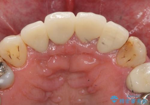 老朽化した前歯のクラウンやりかえの治療後