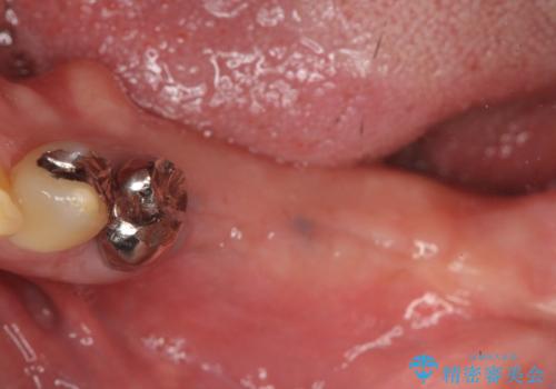 臼歯部インプラント補綴の治療前