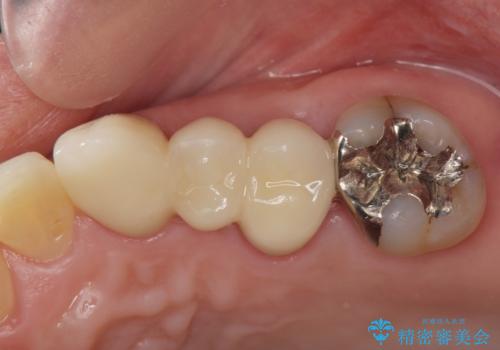 小矯正を伴う臼歯部ブリッジ治療の治療後