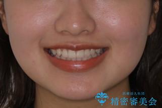 前歯のがたつきをインビザラインで治療の治療前(顔貌)