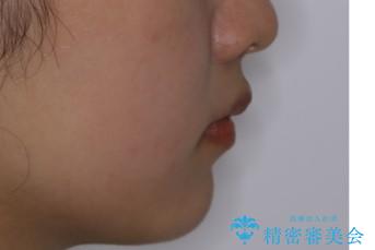 前歯のがたつきをインビザラインで治療の治療前(顔貌)