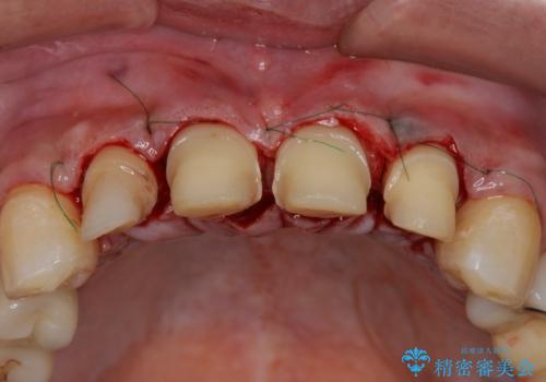 「 放置した虫歯 」 前歯セラミック治療 の治療中