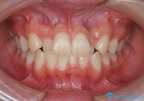 [インビザライン]  前歯のガタつき・すれ違い　マウスピース矯正治療の症例 治療前