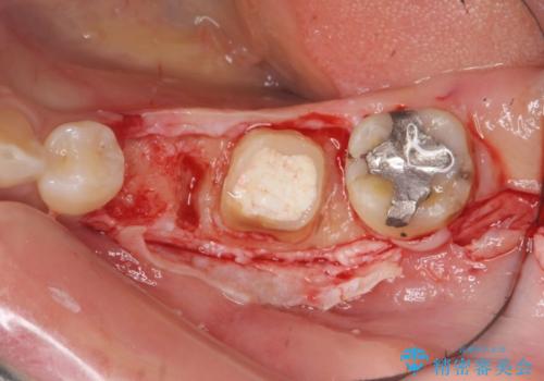 大人になってからの乳歯脱落 セラミックブリッジによる補綴の治療中