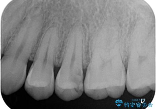 根管治療〜オールセラミッククラウンの治療前