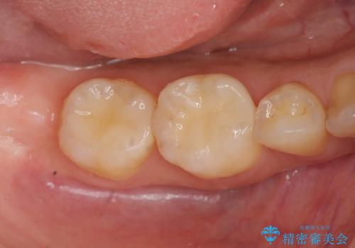 銀歯を白く　セラミックインレー治療