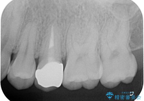 根管治療〜オールセラミッククラウンの治療後