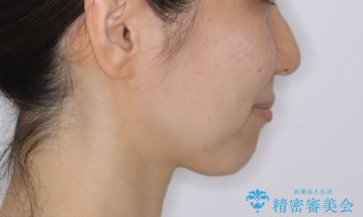 上下の真ん中を合わせて横顔シルエットも改善の治療後(顔貌)