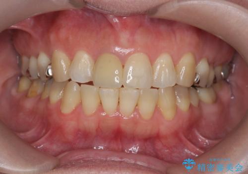 セラミッククラウン　歯ぐきの黒ずみの改善の治療後