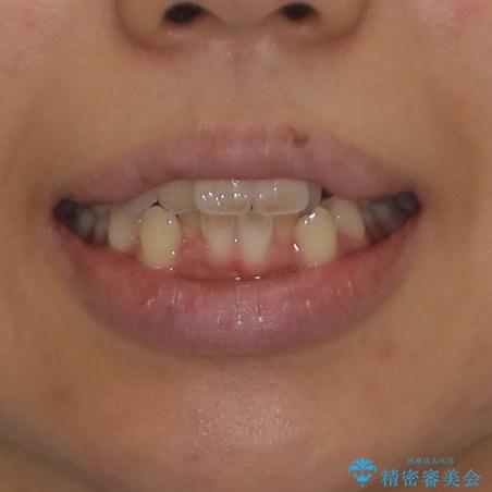 気になる八重歯を治したい 目立たないワイヤーでの抜歯矯正の治療前(顔貌)