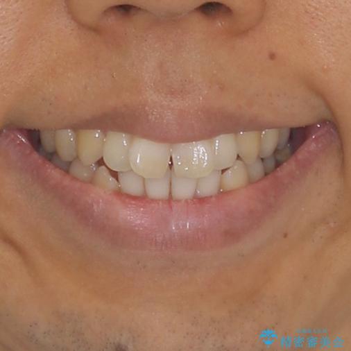 咬み合わせが気になる　ワイヤー矯正による咬み合わせ改善と奥歯のセラミック治療の治療前（顔貌）