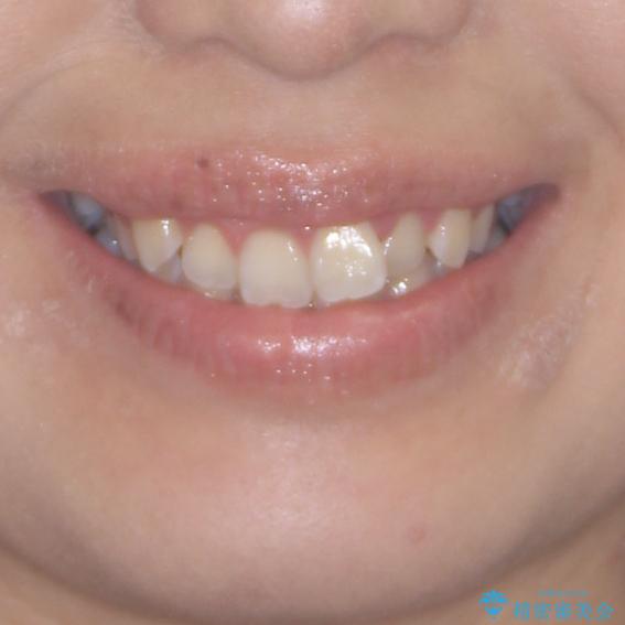 前歯のデコボコをインビザラインでスッキリとの治療前(顔貌)